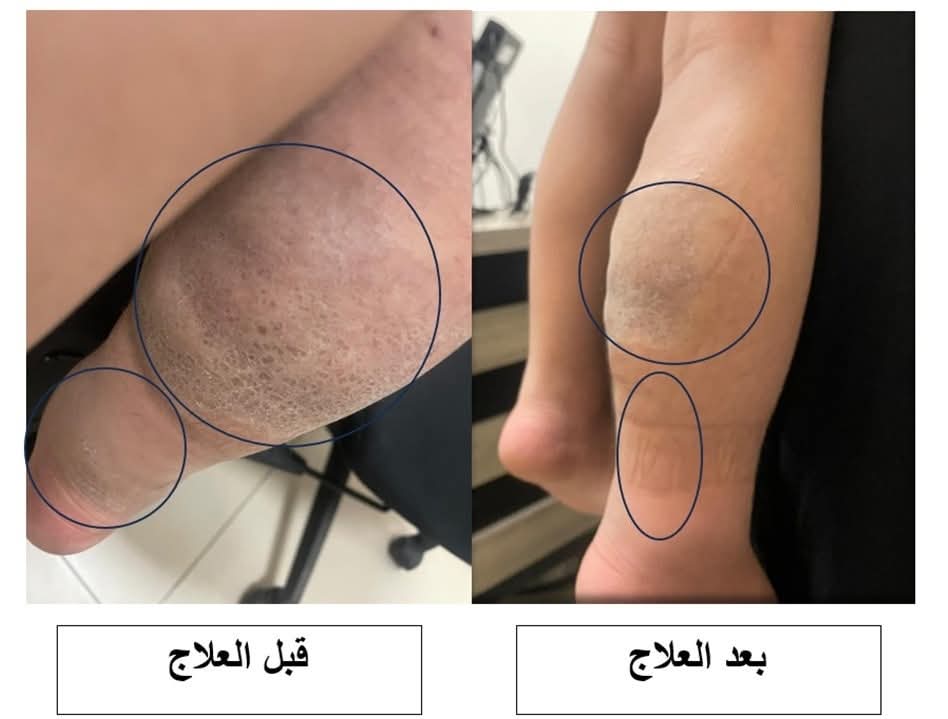 علاج ورم نادر لطفل بمستشفى الملك المؤسس علاج ورم نادر لطفل بمستشفى الملك المؤسس