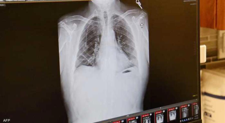 ليس التدخين فقط .. سبب آخر قد يسبب سرطان الرئة ليس التدخين فقط .. سبب آخر قد يسبب سرطان الرئة