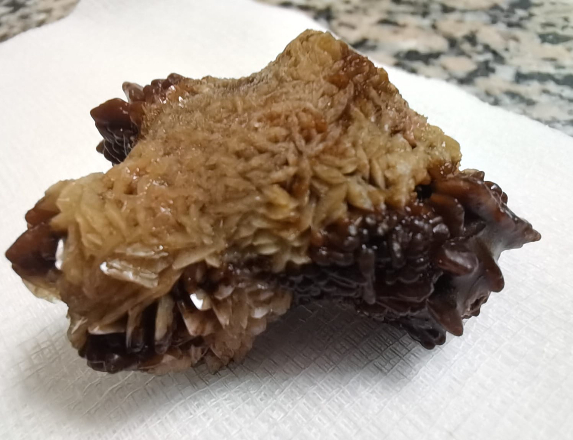 مادبا: عملية نوعية لاستخراج حصوة كبيرة من الكلى باستخدام المنظار